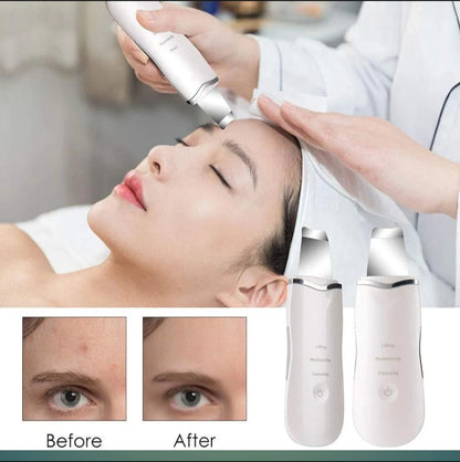 Zefira Glow – Ultrasonic Blackhead Remover &amp; Skin Brightener